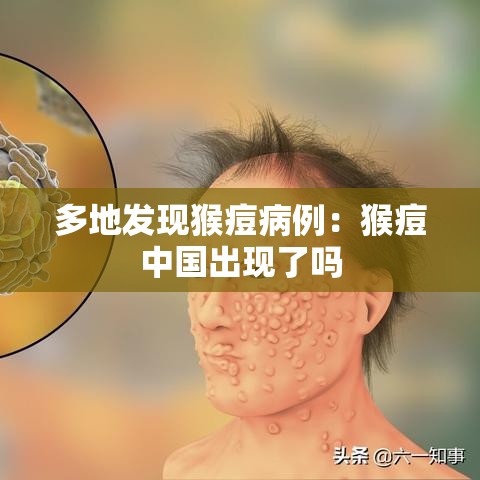 多地发现猴痘病例：猴痘中国出现了吗