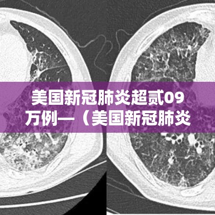美国新冠肺炎超贰09万例—（美国新冠肺炎贰0贰贰）